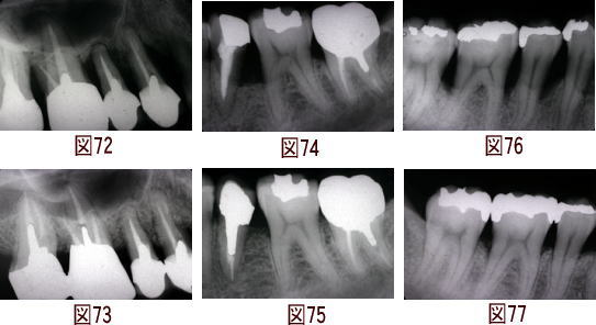 歯周病のレーザー治療の図