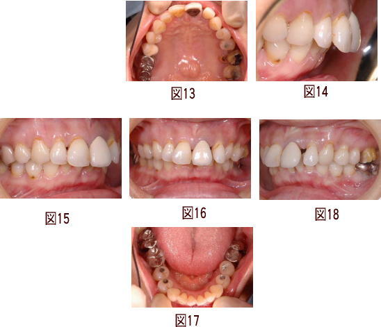 クリスタル歯科の審美治療の症例の図