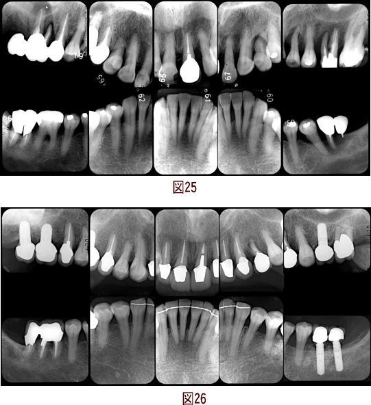 クリスタル歯科の審美治療の症例