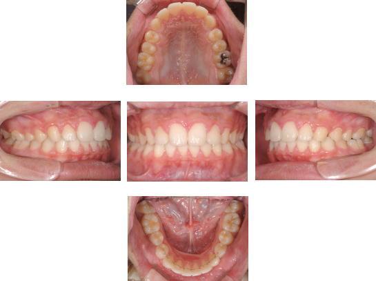 クリスタル歯科の矯正治療の症例